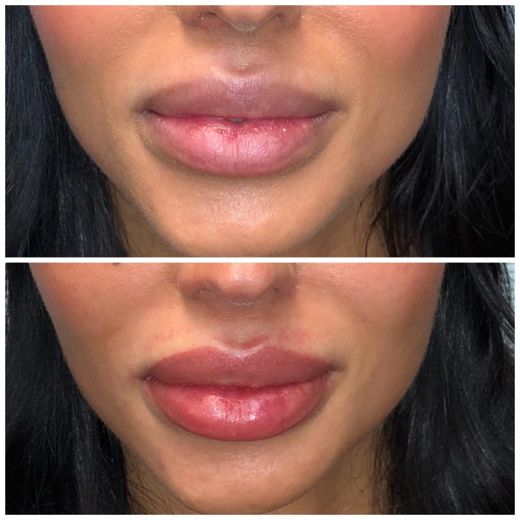 Lip Blushing