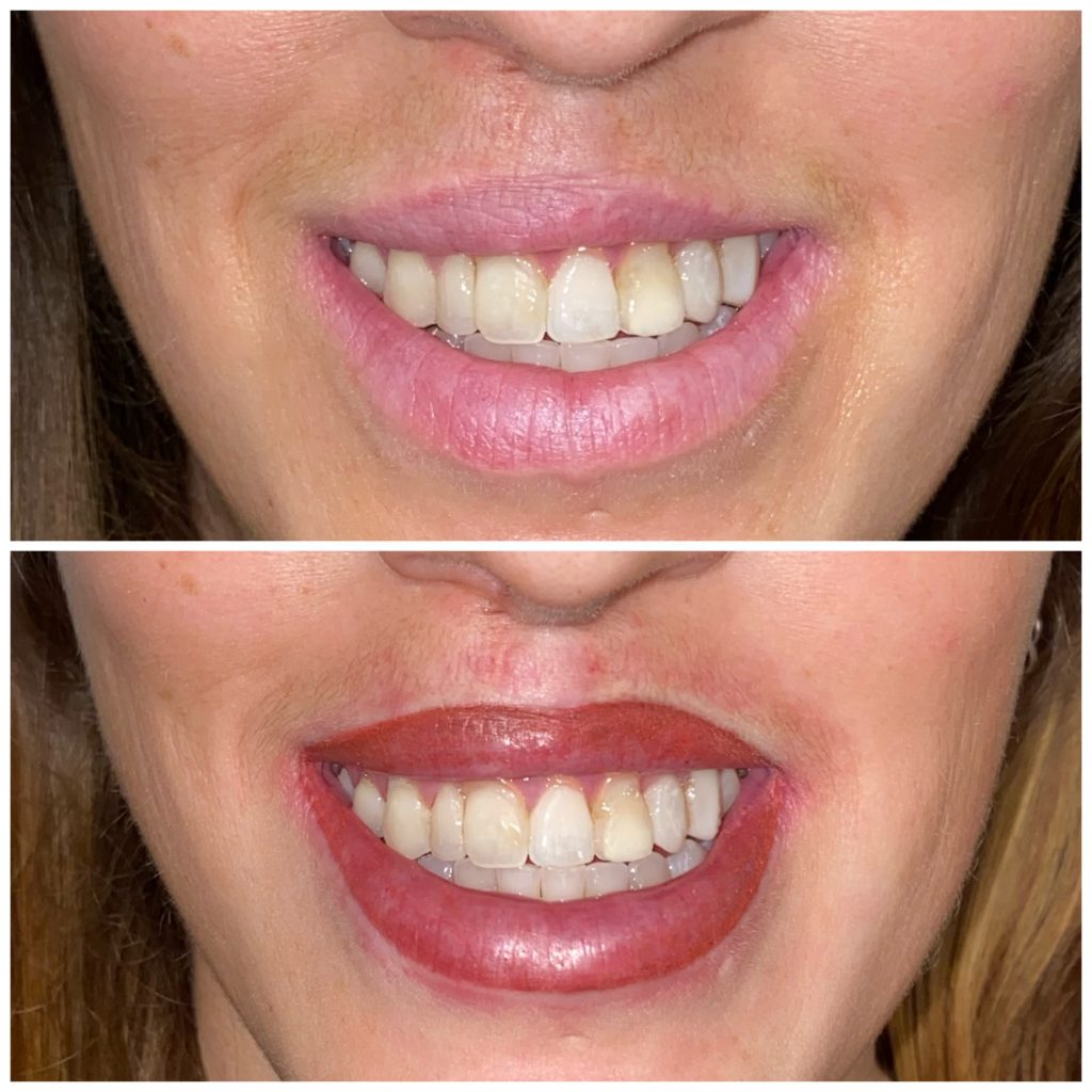Paramedical Lip Tattoo Cleft Lip