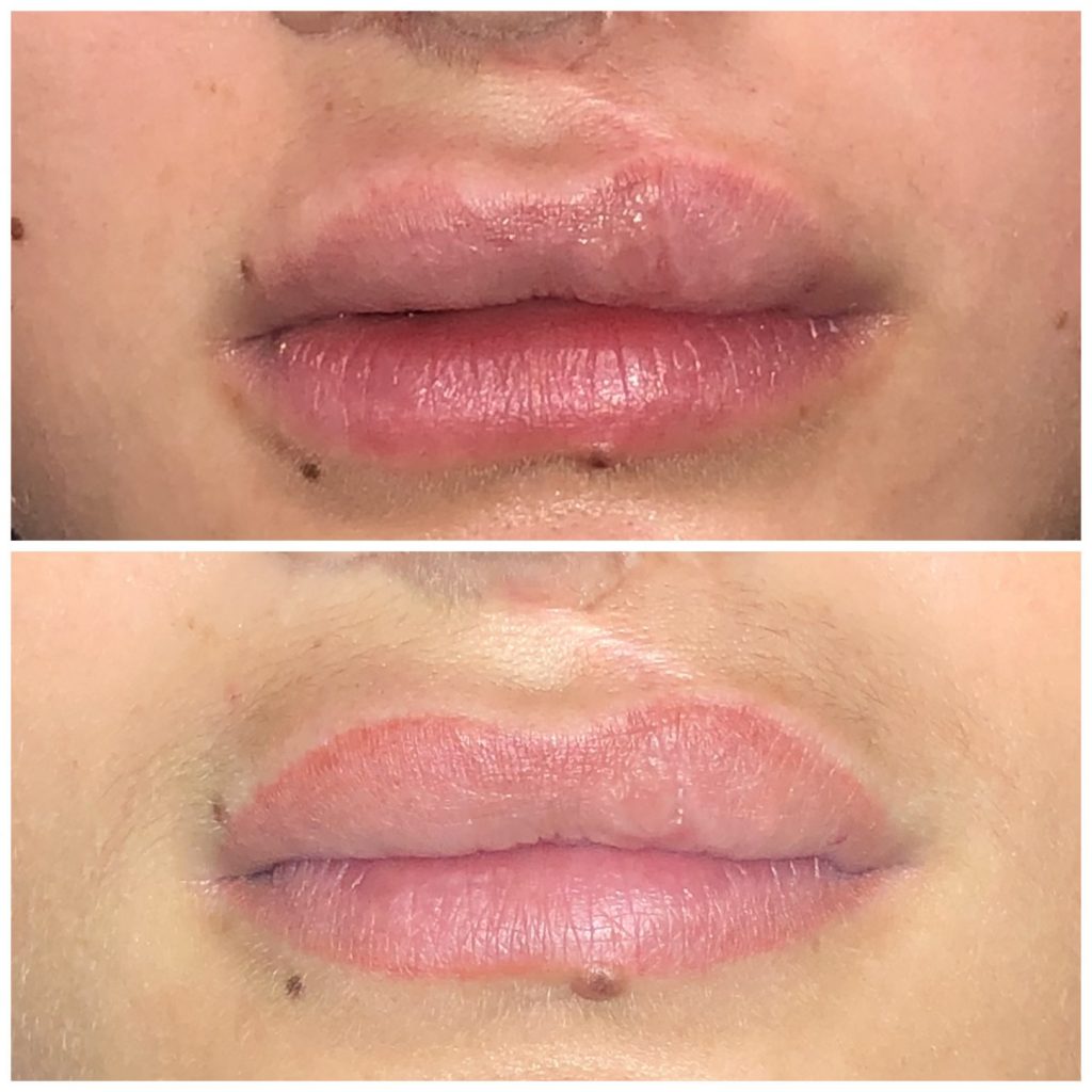 Paramedical Lip Tattoo Cleft Lip