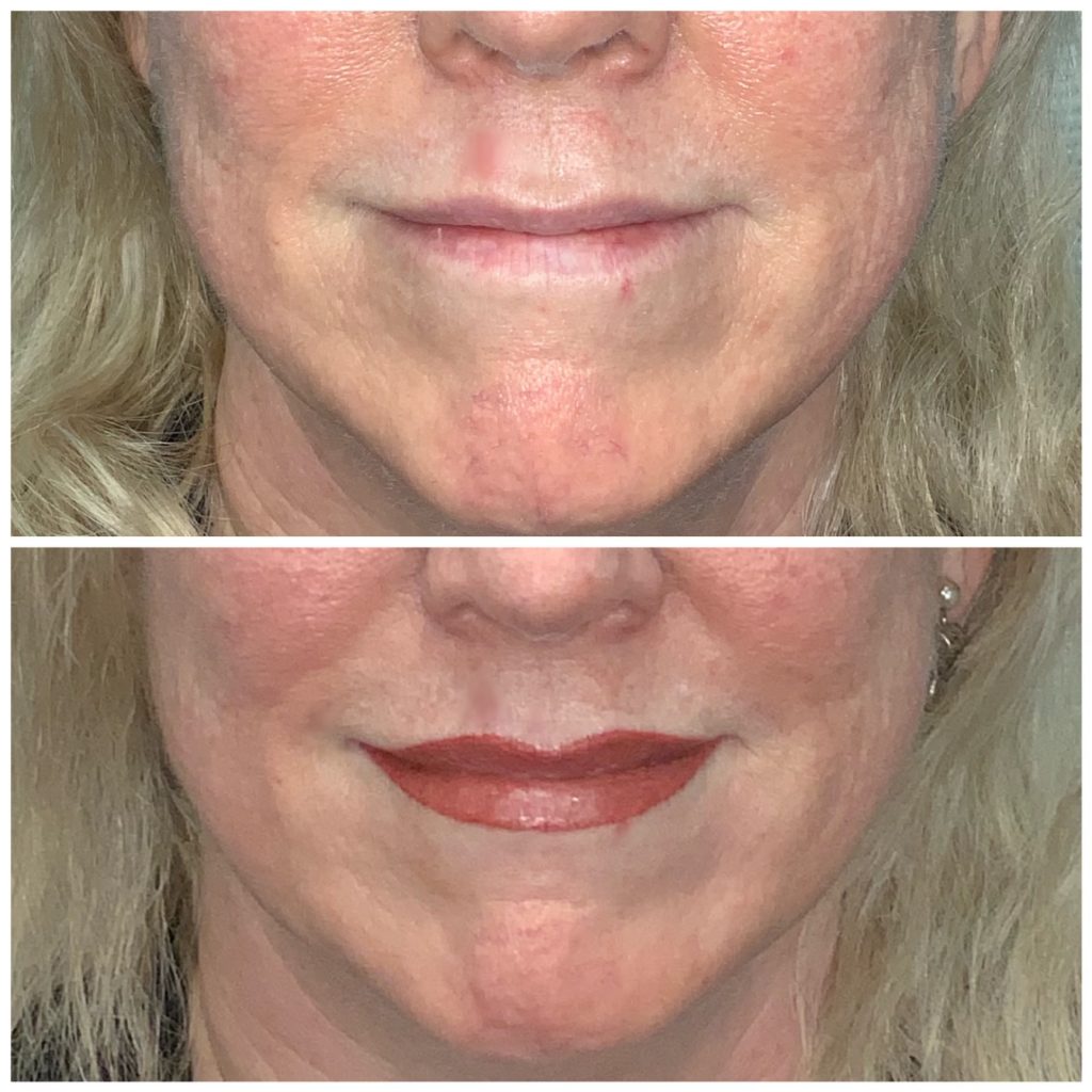 Permanent Lip Color Immediately after procedure