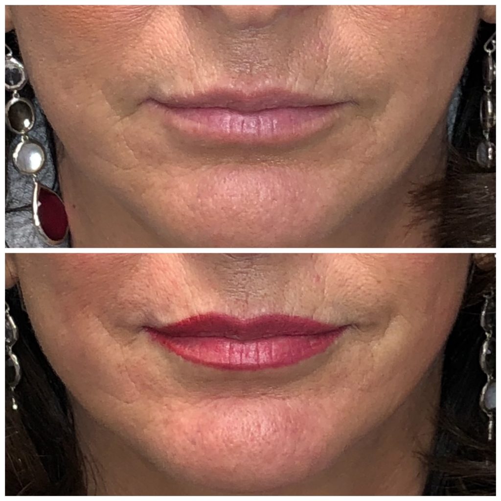 Permanent Lip Color Immediately after procedure