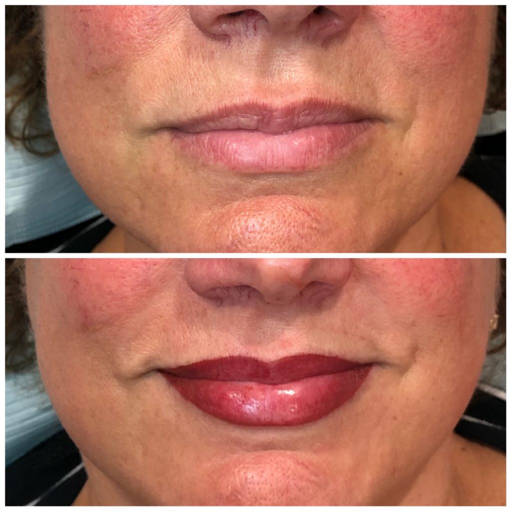 Permanent Lip Color Immediately after procedure
