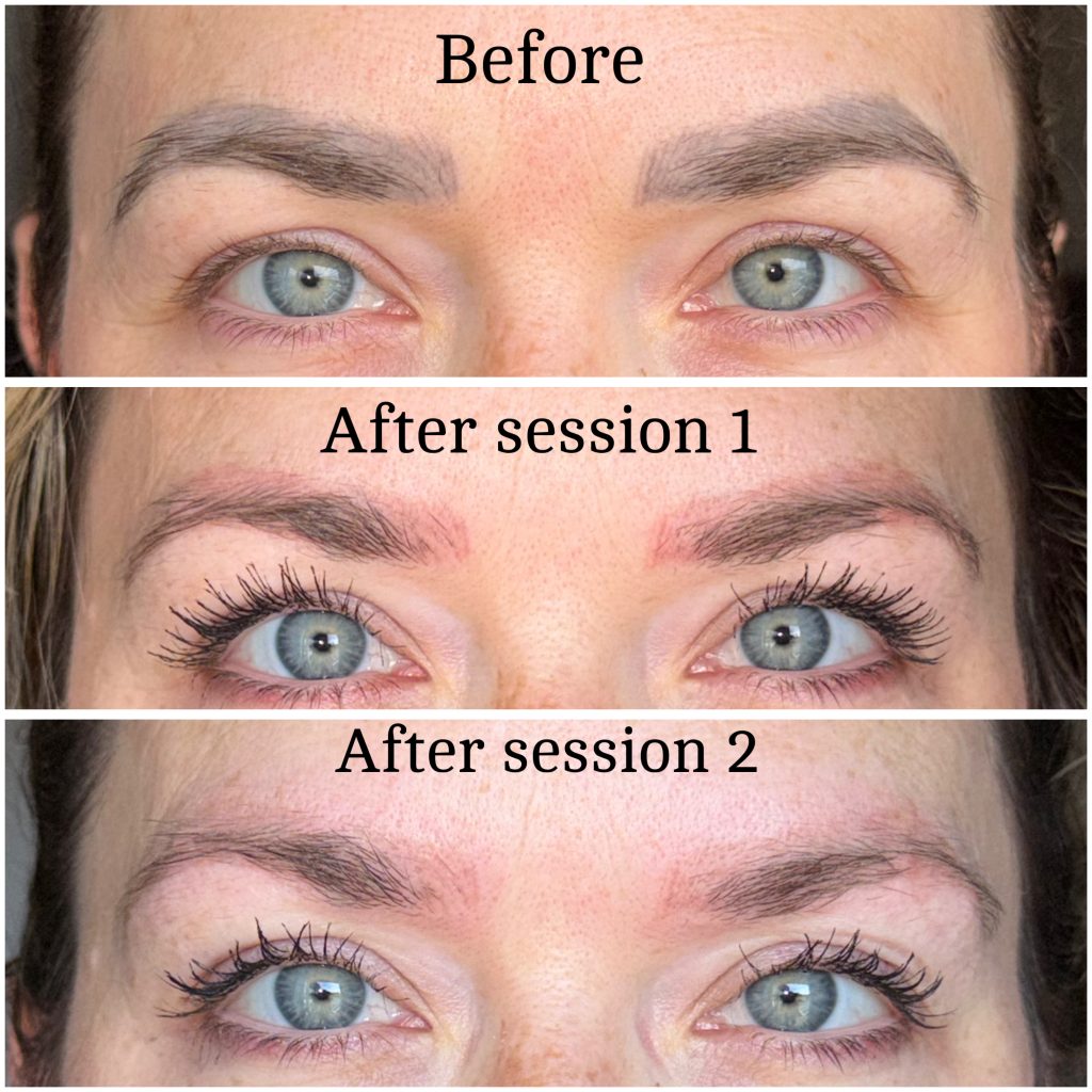 Microblading Removal Before & After Microblading Removal Before & After