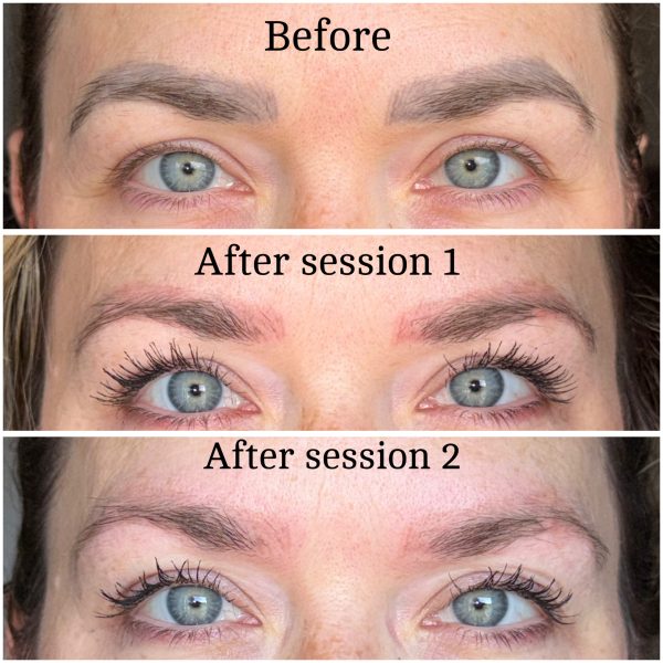 Microblading Removal Before & After