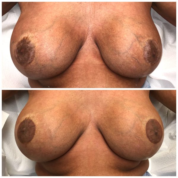 Areola
