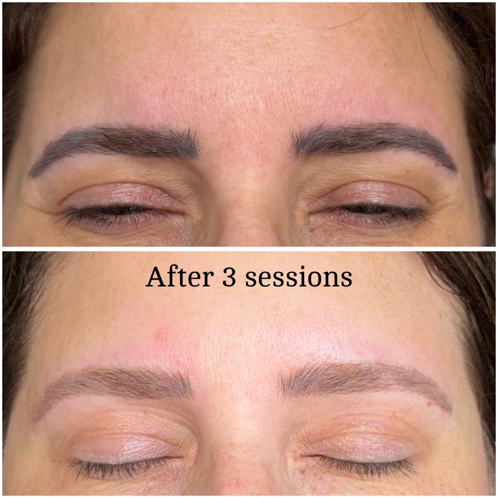 Microblading Removal Before & After Microblading Removal Before & After