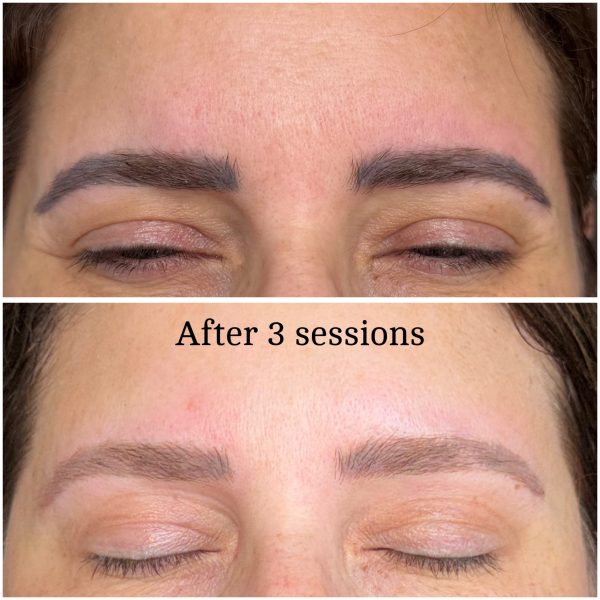 Microblading Removal Before & After