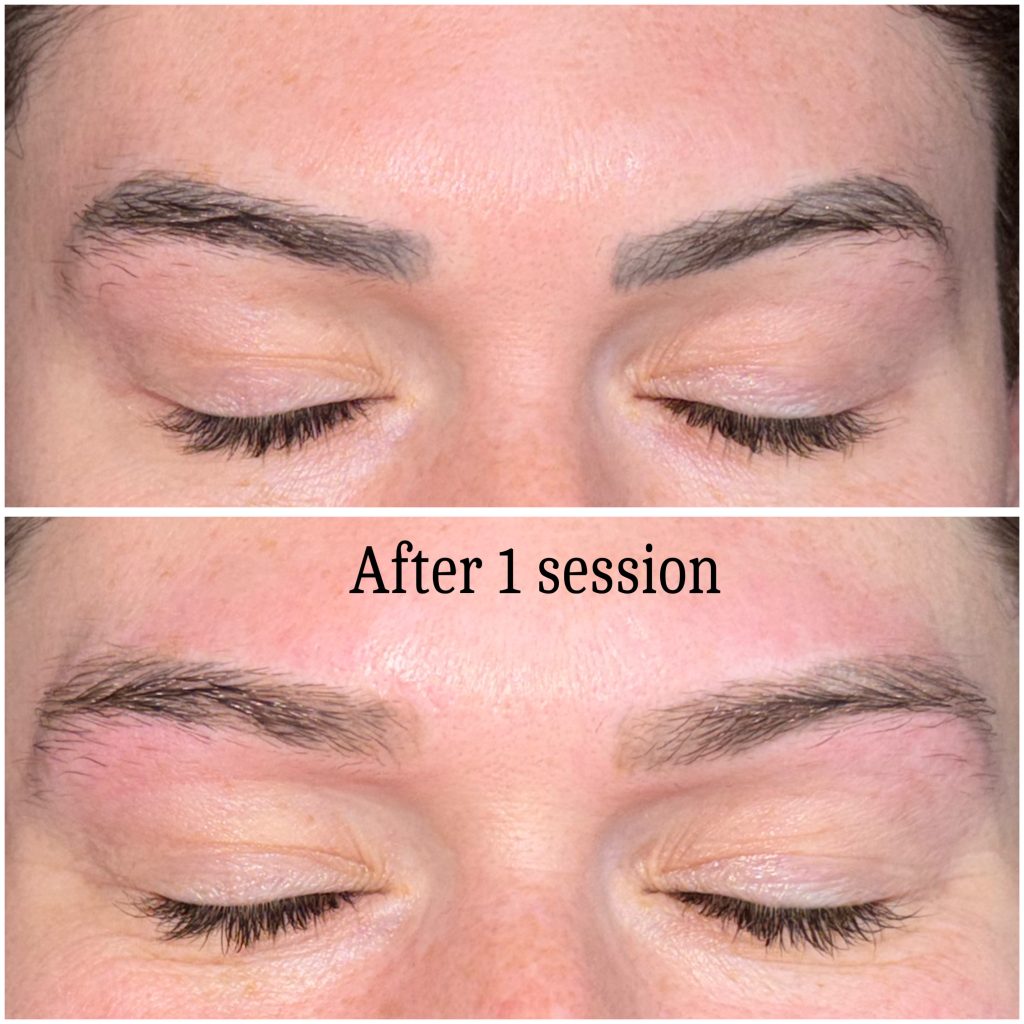 Microblading Removal Before & After Microblading Removal Before & After