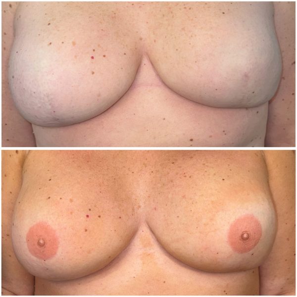 Areola