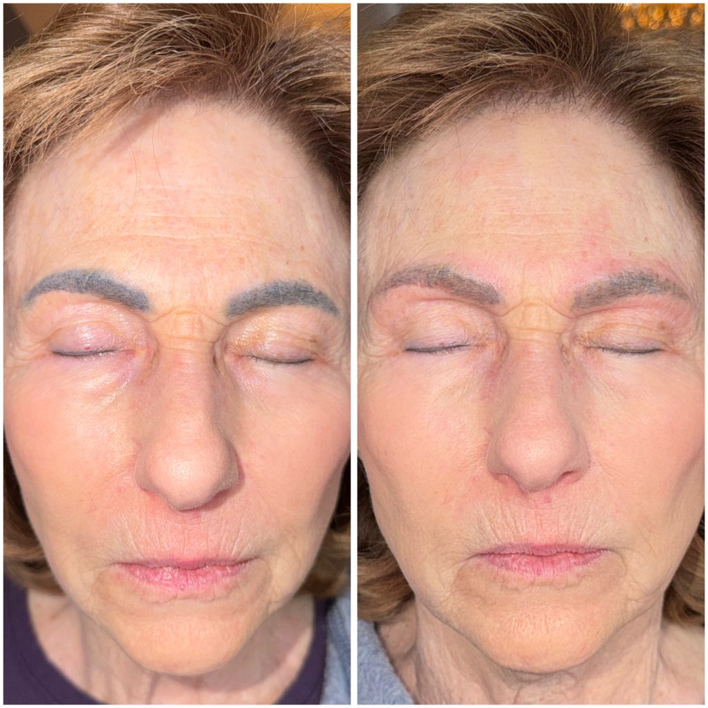 Microblading Removal Before & After Microblading Removal Before & After