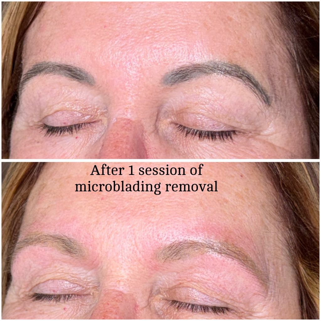 Microblading Removal Before & After Microblading Removal Before & After