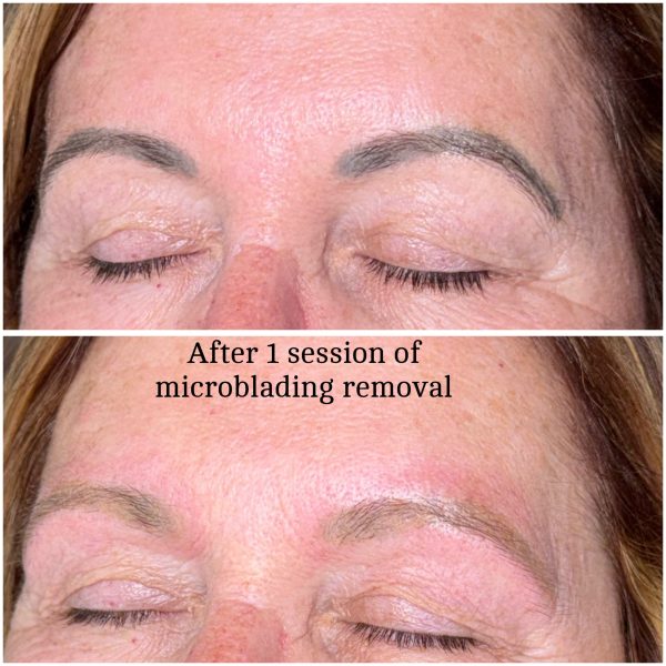 Microblading Removal Before & After