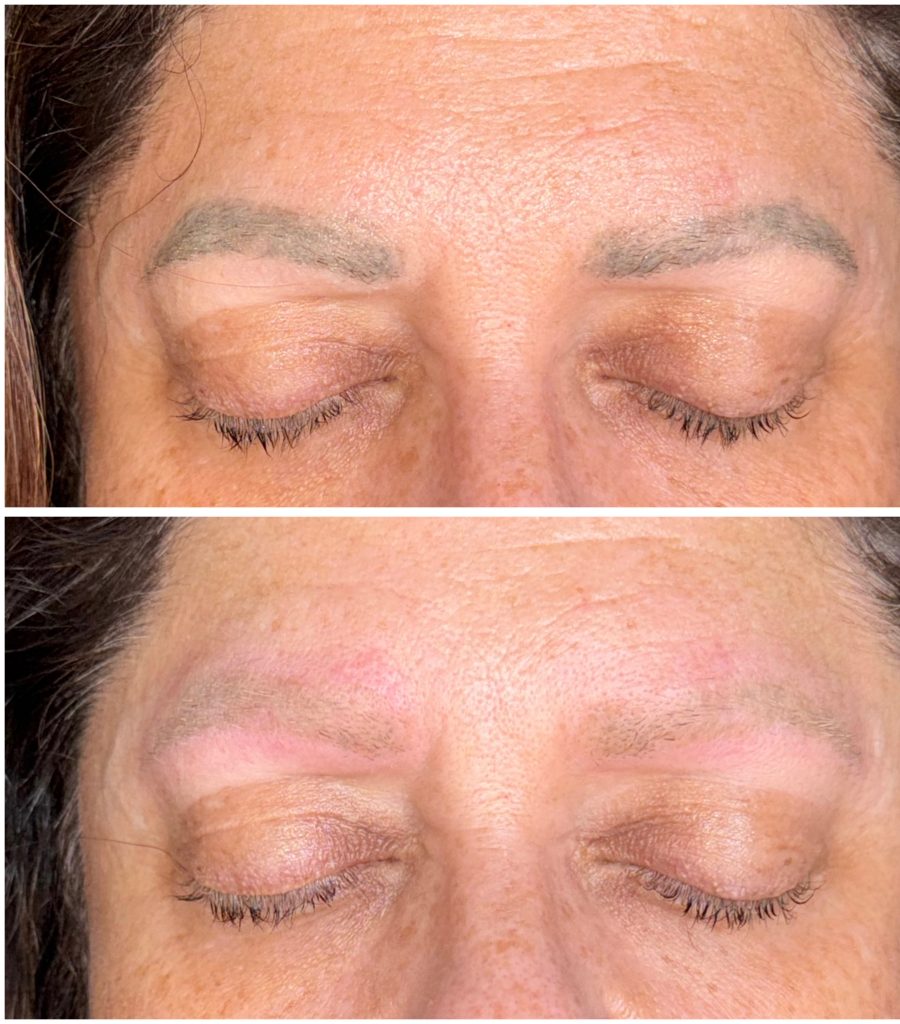 Microblading Removal Before & After Microblading Removal Before & After