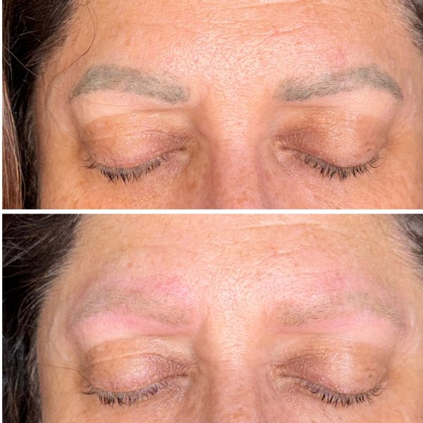 Microblading Removal