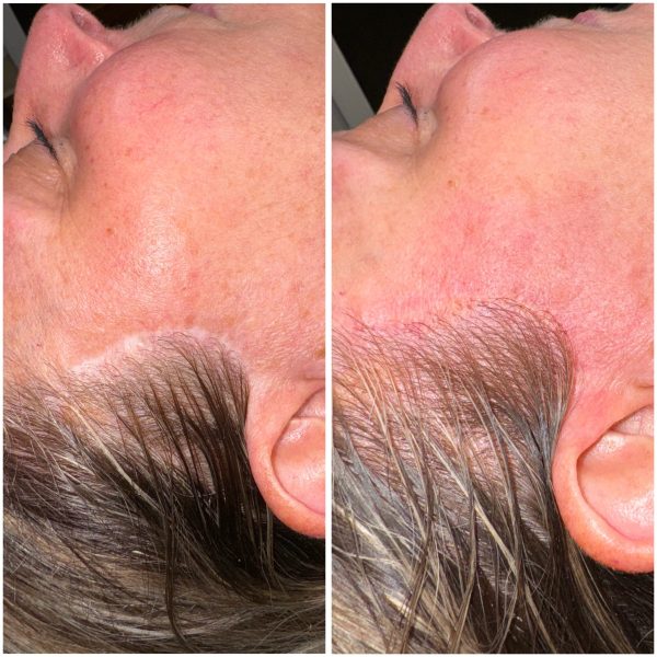 Face lift scars