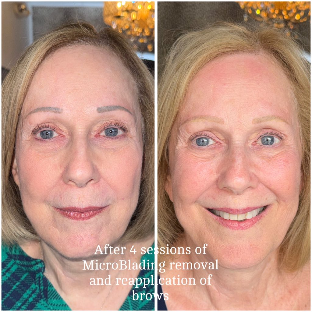 Microblading Removal Before & After Microblading Removal and Reapplication