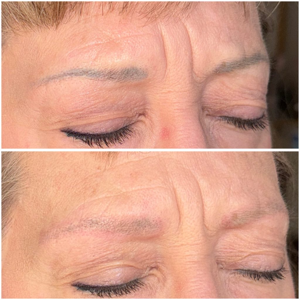 Microblading Removal Before & After Microblading Removal Before & After