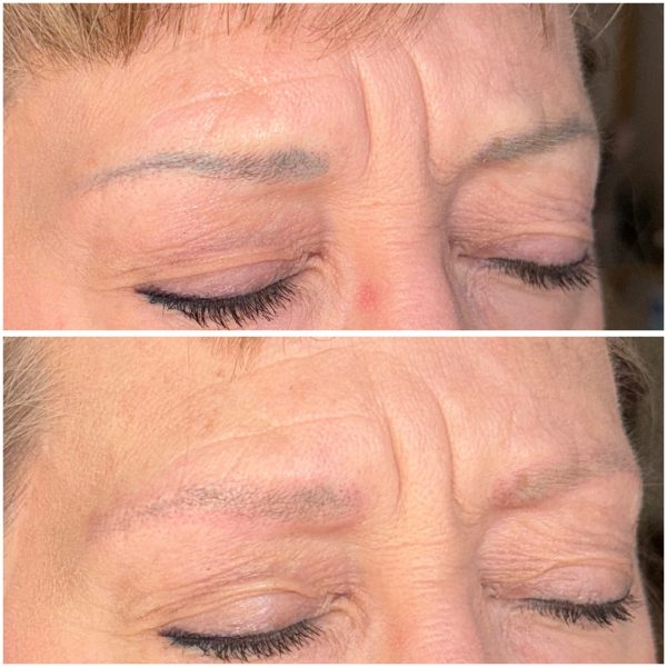 Microblading Removal Before & After