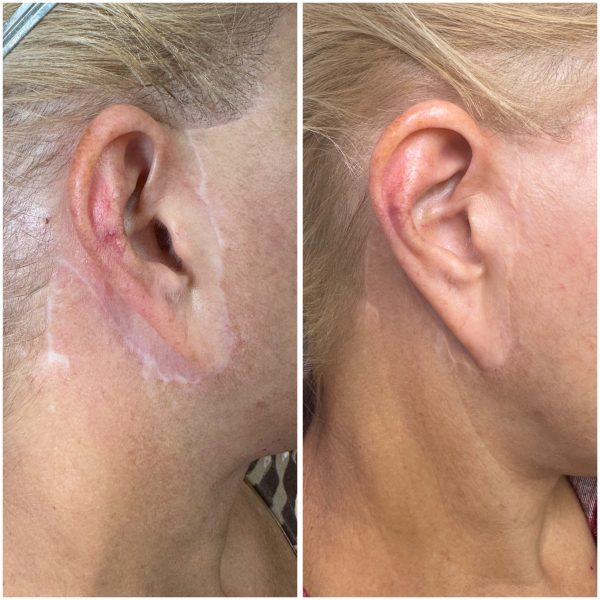 Face lift scars