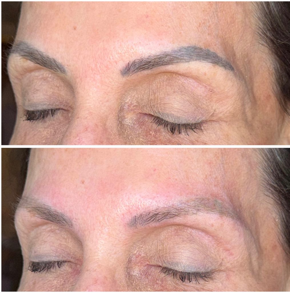 Microblading Removal Before & After Microblading Removal Before & After