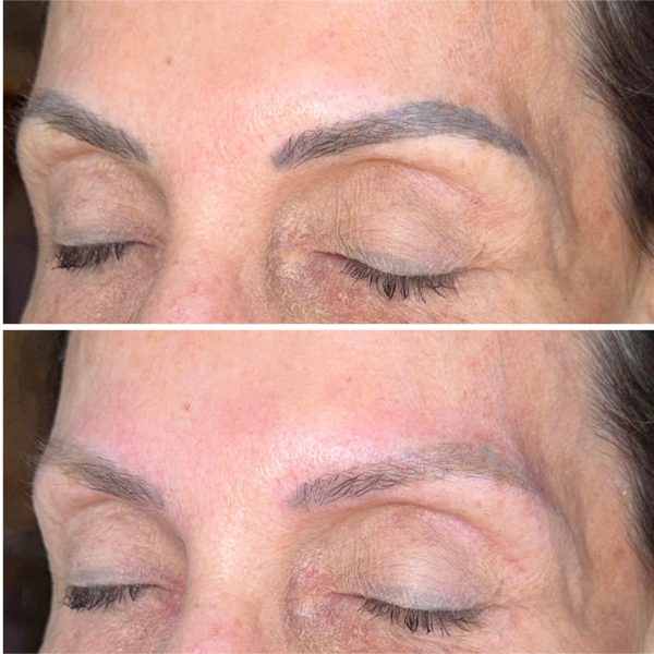 Microblading Removal Before & After