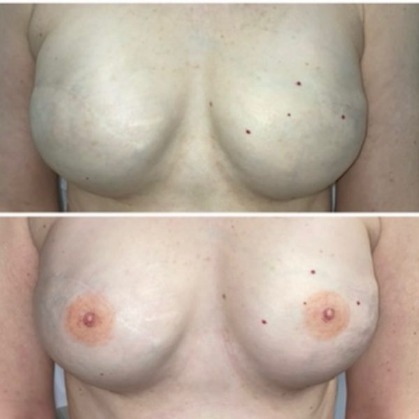 Areola