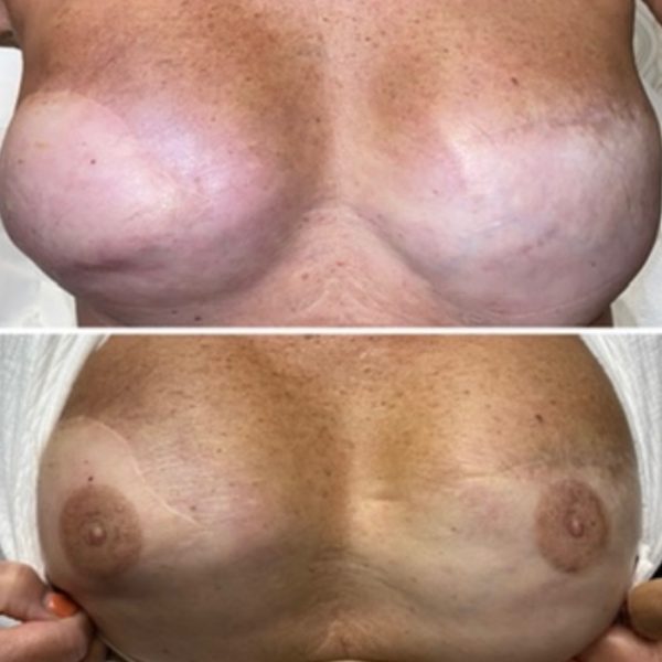 Areola