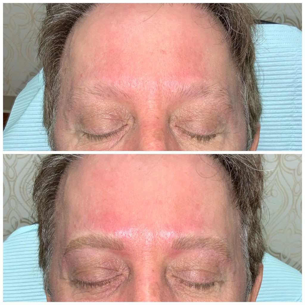 alopecia male
